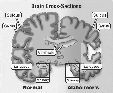 Differential Diagnosis Vascular Dementia Abrupt or step-wise Mixed Lewy Body Fluctuations,