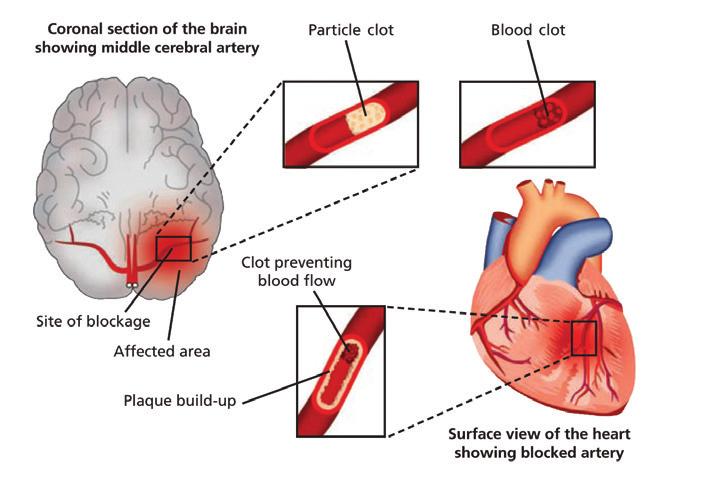 Stroke Stroke is a cardiovascular disease that affects the blood vessels supplying blood to the brain.
