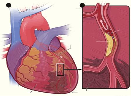 About this booklet The purpose of this booklet is to give you information about the heart attack (or myocardiac infarction) that you have suffered.