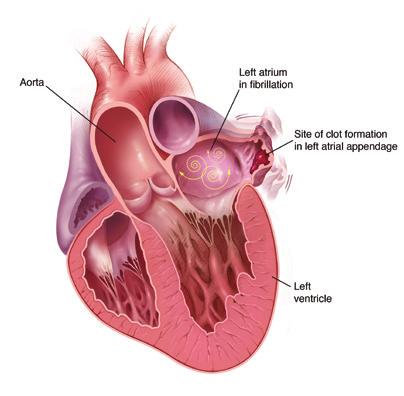 This condition can cause blood to pool and form clots in an area of your heart called the left atrial appendage (LAA).
