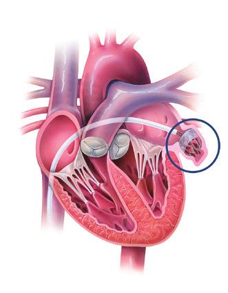 The implant does not require open heart surgery and does not need to be replaced. Your doctor will cross from the right side of the heart to the left side of the heart.