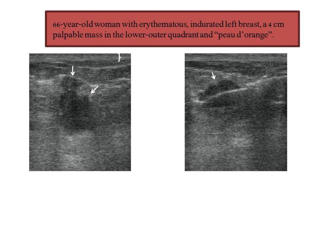 Fig. 5: US shows a large hypoechoic mass (arrows), with irregular, angular margins, corresponding to the clinical