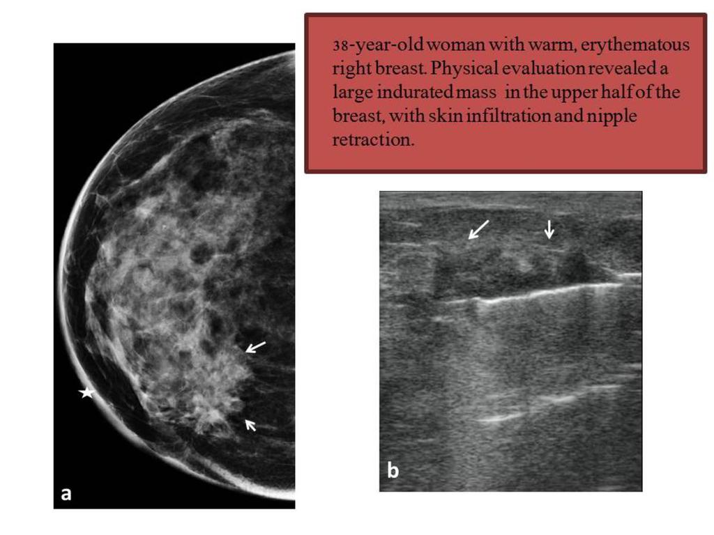 Fig. 6: Craniocaudal mammography (a) reveals skin thickening (star) and architectural distorsion.