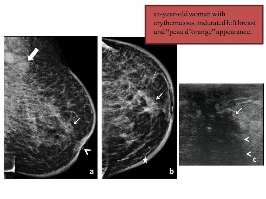Fig. 7: Medio-oblique (a) and craniocaudal (b) mammography show in the retroareolar region an irregular mass with spiculated margins (small arrow) that includes microcalcifications and associates
