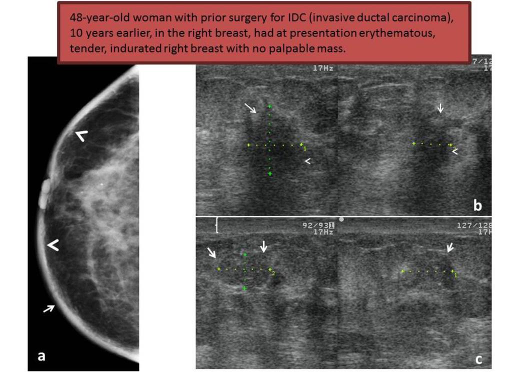 Fig. 8: Mammography (a- craniocaudal incidence) shows skin thickening (arrows), trabecular coarsening (arrowheads), diffuse stromal coarsening and architectural distortion.