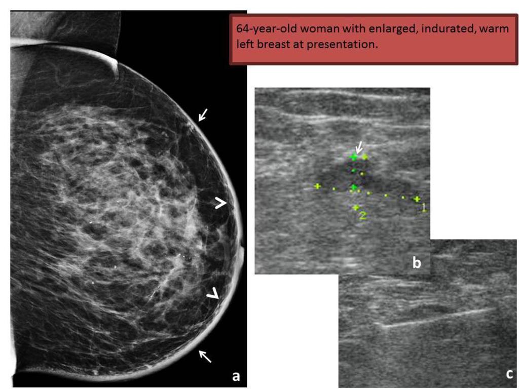 Fig. 2: Mediolateral oblique mammogram (a) shows only skin thickening (arrow) and trabecular coarsening (arrowhead) of the left breast and some benign bilateral calcifications.
