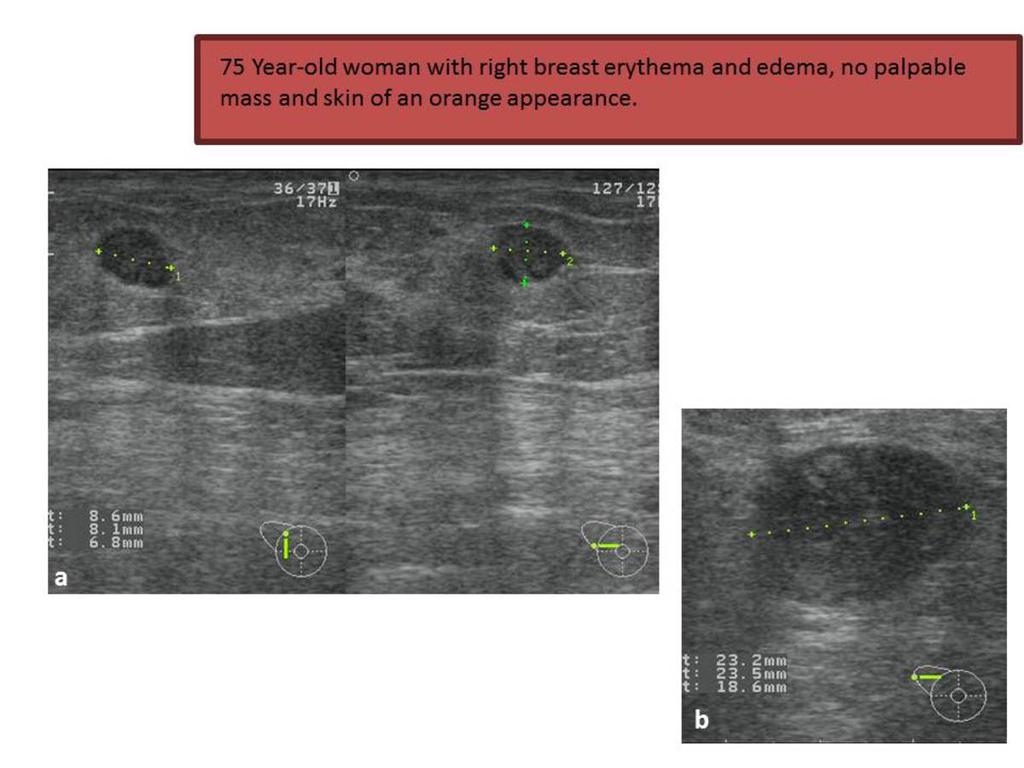 Fig. 3: US shows skin thickening (star), diffuse edema in the adipose tissue with no suspect hypoechoic mass except for one small node suggestive for intramammary adenopathy in the upper-outer