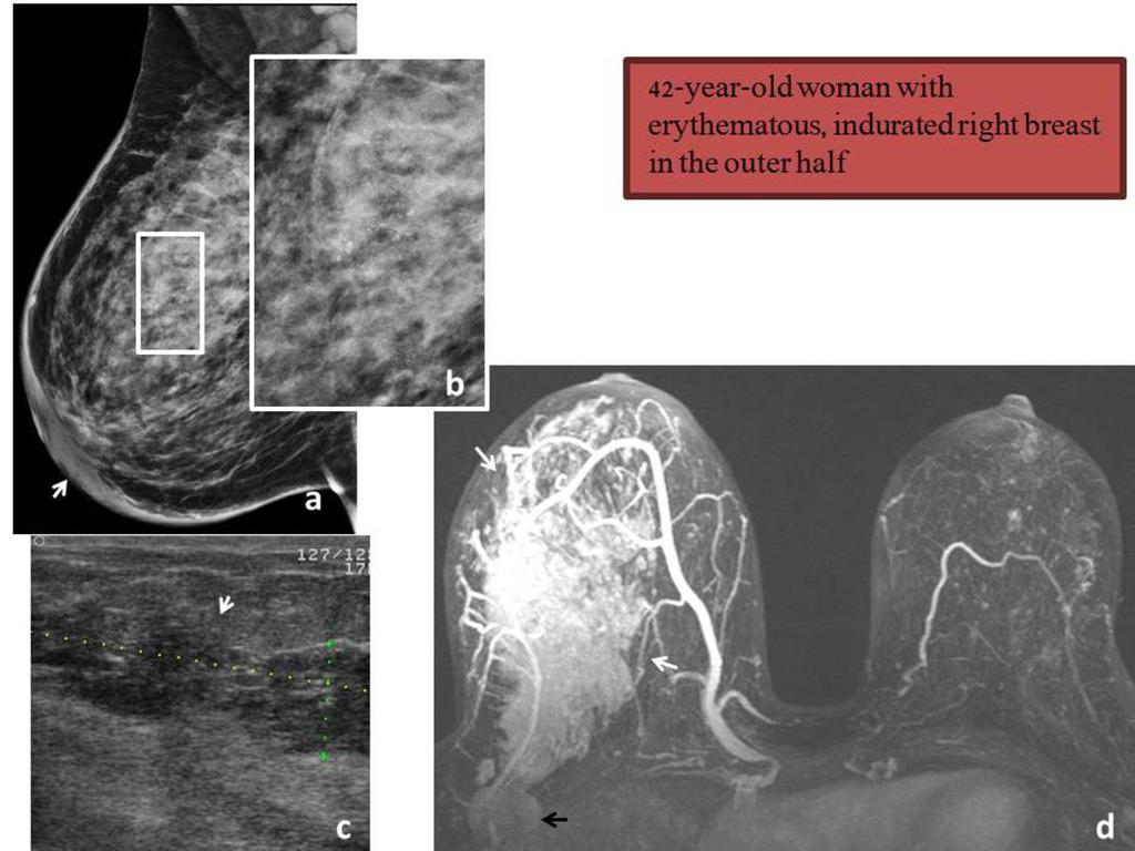 Fig. 4: Medio-oblique mammography (a): skin thickening and trabecular coarsening (arrow), stromal coarsening in the upper quarters and polymorphic microcalcifications (b) indicative of comedonecrosis.