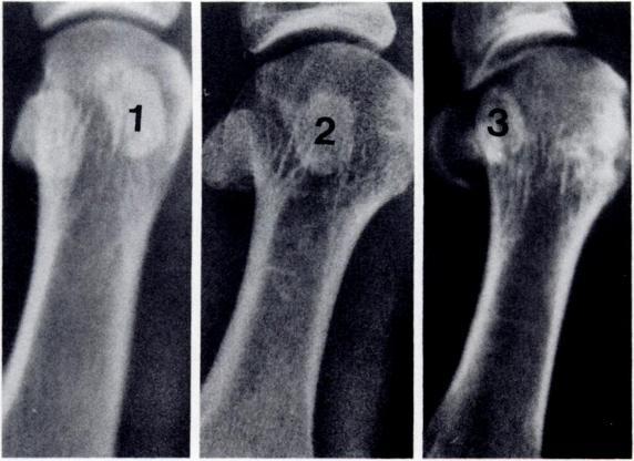 4, First intermetatarsal angle: angle between long axis of first and second metatarsals (N < 10#{176}). degree of degenerative joint disease (Fig. 9), degree of pronation of the hallux (Fig.
