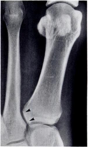 c, Round joint: enhances mobility of joint and medial deviation of metatarsal. Fig. 7.