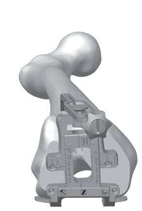 SECTION 3 Size Femur and Establish External Rotation Size Femur and Establish External Rotation Rotate the feet of the Anterior Referencing Sizer so the appropriate Left or Right markings are visible