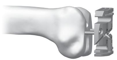A The flatness of the bone and stability of the 4-in-1 Cut Guide on the femur is critical to ensuring sufficient contact between the implant and the bone.