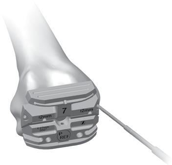 Complete Femoral A/P and Chamfer Resections SECTION 4 TECHNIQUE TIP 4.C If there is a risk of anterior notching, the 4-in-1 cut guide can be removed, rotated 180 and be replaced on the distal femur.