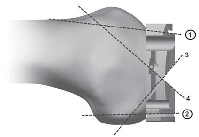 The 4-in-1 guide then needs to be removed, rotated 180 and be placed on the distal femur in the anteriorized holes. This will result in a 2mm anterior shift of the 4-in-1 femoral resections.