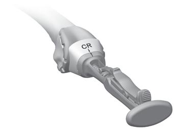 CR Femoral Finishing SECTION 5 Remove any posterior osteophytes or overhanging bone on the femur to facilitate maximum knee flexion.