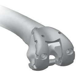 the handle on the Femoral Inserter/ Extractor to secure the PS Femoral Provisional (Fig. 32). Place the correct PS Femoral Provisional onto the femur in the desired medial/lateral position.