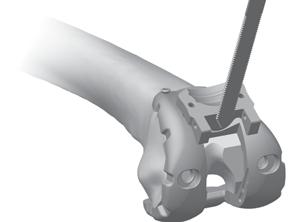 Control the saw to avoid over resection of the medial and lateral condyle in the proximal area of the PS box (Fig. 35a).
