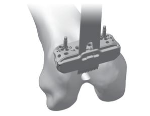 Resect Distal Femur SECTION 2 Squeeze the button on the resection guide (Fig. 11) to release and remove the alignment guide and resection guide assembly from the cutting head.