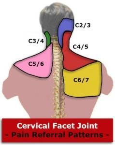 Symptoms of cervical facet syndrome: This condition can cause a number of symptoms, depending on the location and severity of the joint deterioration.