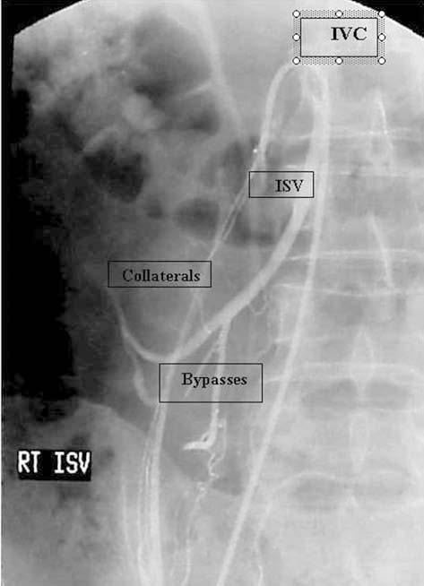 Figure 1. Right varicocele with associated network of bypasses and retroperitoneal collaterals. The right internal spermatic vein (ISV) inserts into the inferior vena cava (IVC).