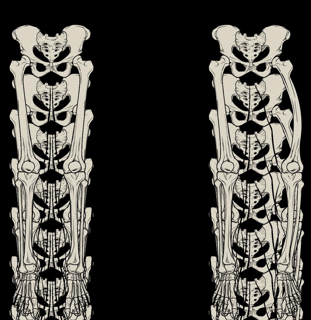 OpenStax-CNX module: m46281 11 Paget's Disease Figure 8: Normal leg bones are relatively straight, but those aected by Paget's disease are porous and curved.