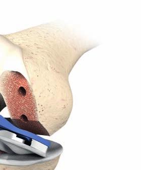 Lower the anterior of the prosthesis into position. This sequence promotes the flow of cement from posterior to anterior as the prosthesis is seated.