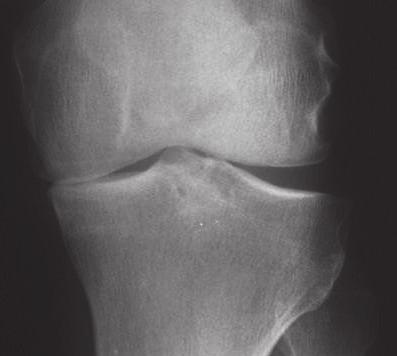 Indications, Contra-indications and X-ray Templating Indications Unicompartmental knee replacement is indicated for patients with osteoarthritis isolated to the medial or lateral tibio-femoral