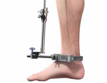The tibial jig uprod and ankle clamp are designed to prevent an adverse reverse slope.