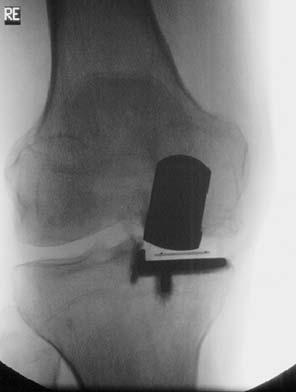 358 Knee Surg Sports Traumatol Arthrosc (2007) 15:356 360 Fig. 1 Malalignment of femoral component compartment syndrome of the lower leg, which are rare complications of knee arthroplasties.