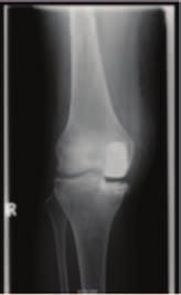 (KSCR), Oxford Questionnaires, and the alignment of the knees before surgery, six and two post-surgery were analysed.