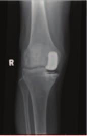 Management of Periprosthetic Fracture in UKA Patients operation. All of them sustained fractures at the medial tibia plateau with mild displacement noted on initial radiographs (Fig. 1, 2, and 3).