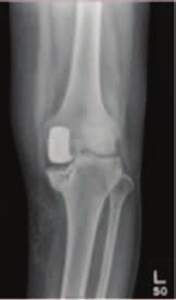 The five patients who presented a month after surgery were offered either revision to total knee replacement or surgical fixation but they opted not to have surgical intervention initially and were
