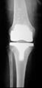 them. The total knee replacement may also involve replacing the surface of the kneecap, if needed.