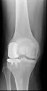 Femur Tibia Unicompartmental (partial) knee replacement If your arthritis only affects one part of your knee, it may be possible to