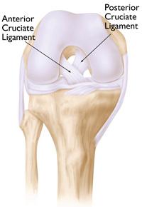 The tibial component is typically a flat metal platform with a cushion of strong, durable plastic, called polyethylene.