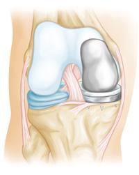 If only one side of the knee joint is damaged, smaller implants can be used (unicompartmental knee replacement) to resurface just that side.
