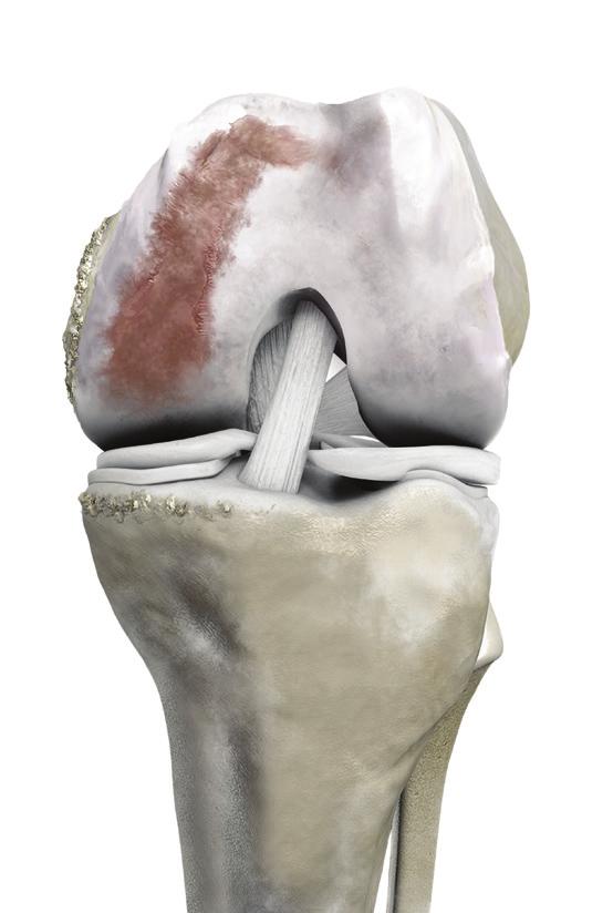 UNDERSTANDING YOUR KNEE To understand the benefits of the ConforMIS personalized approach, it s important to understand the anatomy of your knee.