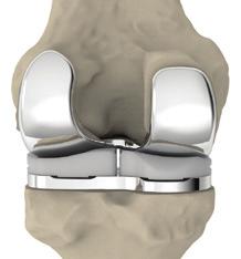 Sue, bilateral itotal recipient Sue s Knees Knee replacement is a very common procedure.