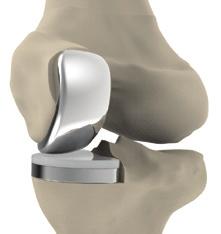 ConforMIS implants are specifically designed to