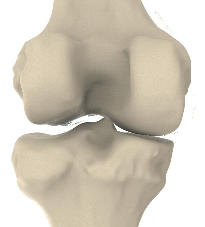 Off-the-shelf knee implants aren t designed to match the natural offset joint line that