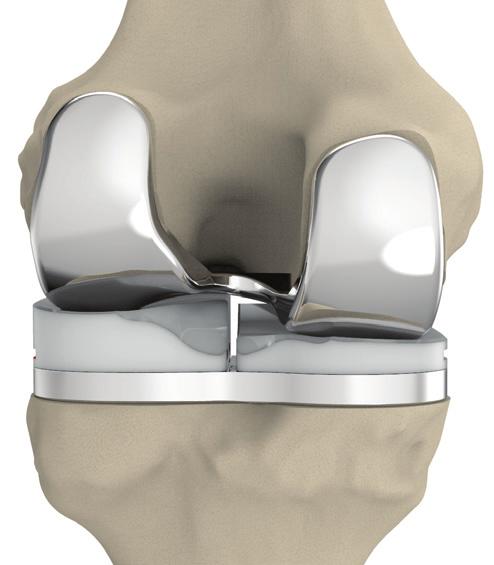 ConforMIS implants maintain the patient s medial and lateral joint lines, which allows for