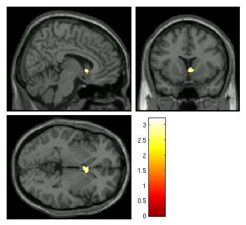 striatum. No significant differences in brain activation between medication groups were found during anticipation of reward at baseline or at follow-up. Figure 1.
