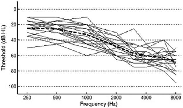 146 REINHART ET AL. / EAR & HEARING, VOL. 37, NO. 2, 144 152 Fig. 1. Individual participant audiograms for their test ear; group mean thresholds in dotted black line.