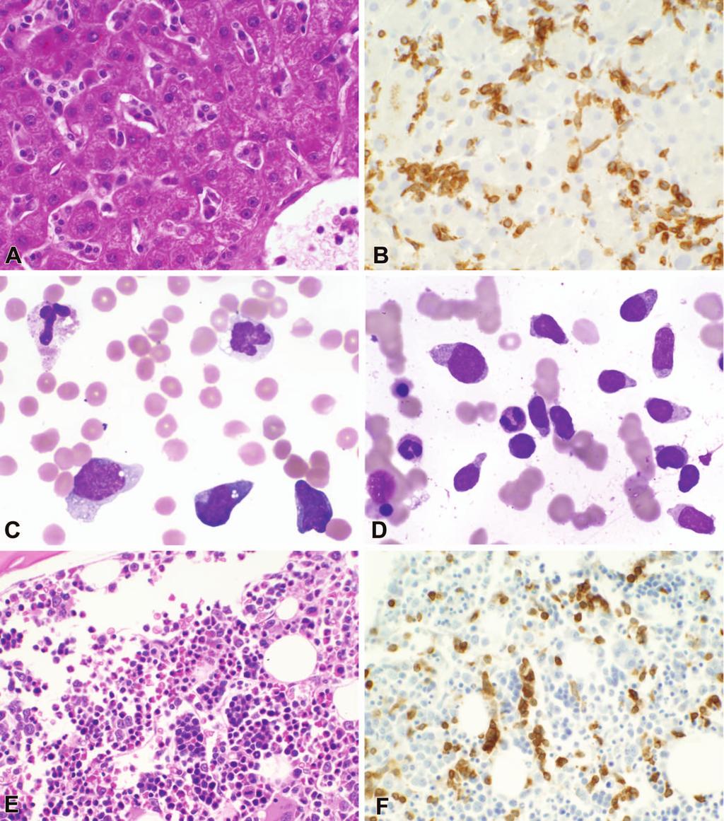 Figure 2. Morphologic features and immunohistochemical findings in hepatosplenic T-cell lymphoma (HSTL).