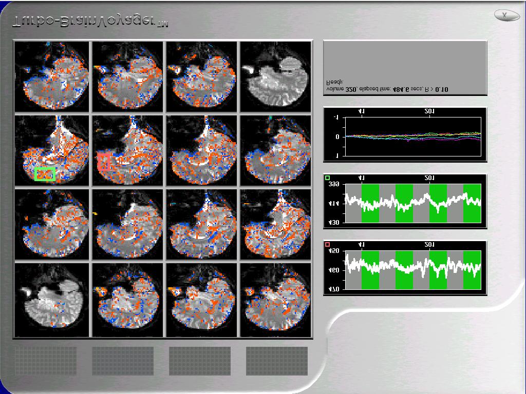 5. The Turbo-Brain Voyager: fmri Biofeedback The Turbo