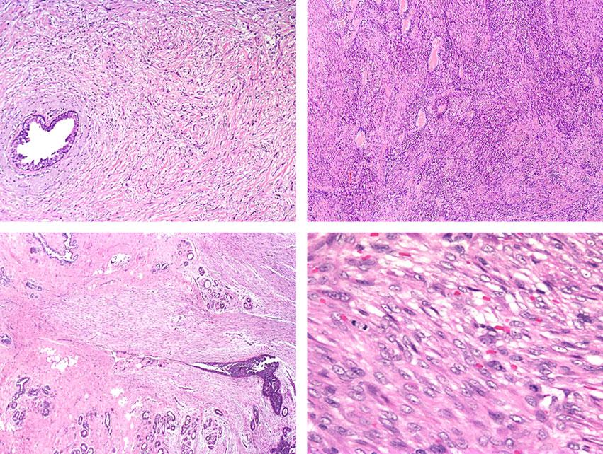 Spindle cell lesions of the breast 39 A B Figure 2. The morphological overlap between different entities of bland-looking spindle cell lesions of the breast.
