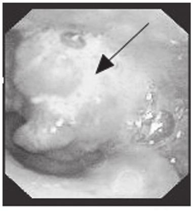 Endoscopy of case three demonstrated the mass on the posterior wall of the hypopharynx. Figure 4. Computed tomography findings of case two showed a 1.5x1.
