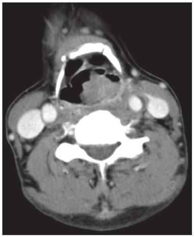 In addition, external radiotherapy was administered at the Taizhou Hospital (Taizhou, China). Metastases and recurrence were not clinically apparent at the 5.