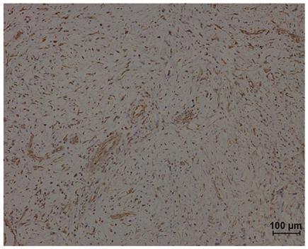 Immunohistochemistry revealed that the SCC component was strongly positive for cytokeratin (CK) and the spindle cell component was strongly positive for vimentin (VM; Fig. 9).