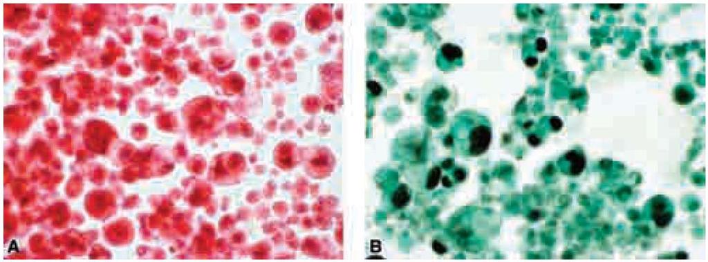 TTF-1 Positive cells in pleural fluid of an adenocarcinoma